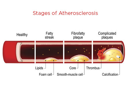 cardiovascular exercise